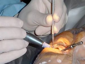 Best PRK eye surgery Newport Beach,